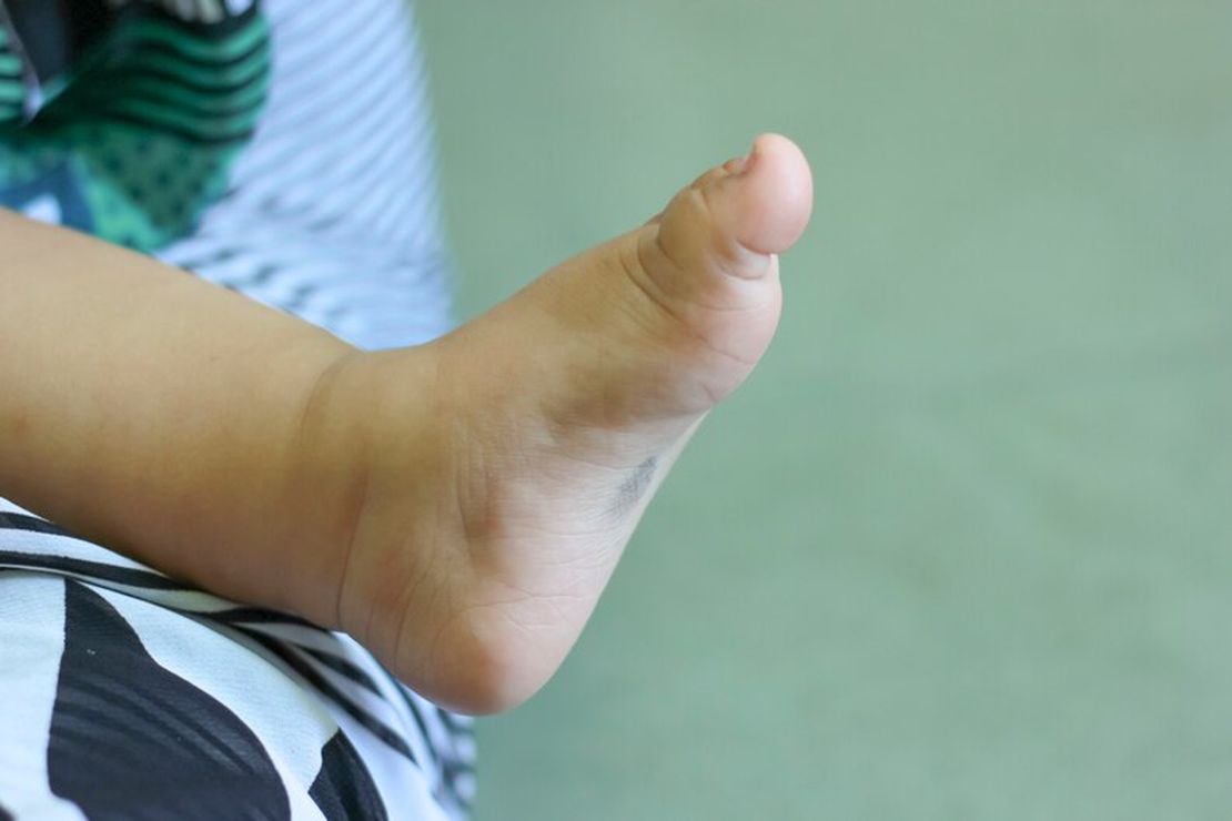 Burger Disease and Wound Care: Effective Methods for Diabetic Foot